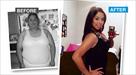 weight loss surgery in tijuana mexico
