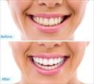 lewisville dental implants braces