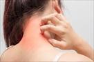 best eczema treatment specialist nyc | marie hay