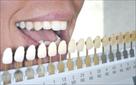 raleigh teeth whitening