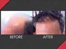 maxim hair restoration