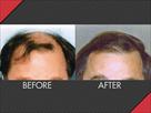 maxim hair restoration