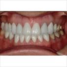 prosthodontics implants northwest