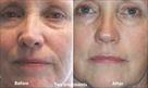 get the results of surgery for face lifting inch